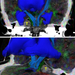 acoustic neurinoma and its environment, ventricles