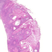 carcinoma planocellulare cutis 0