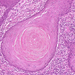 carcinoma planocellulare cutis paraceratozis