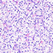 adenocarcinoma renis2