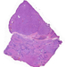 Carcinoma hepatocellulare