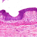carcinoma transitiocellulare ép pyelon