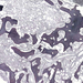myelofibrosis (reticulin)0