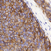 carcinoma ductale invasivum mammae (Her-2)0